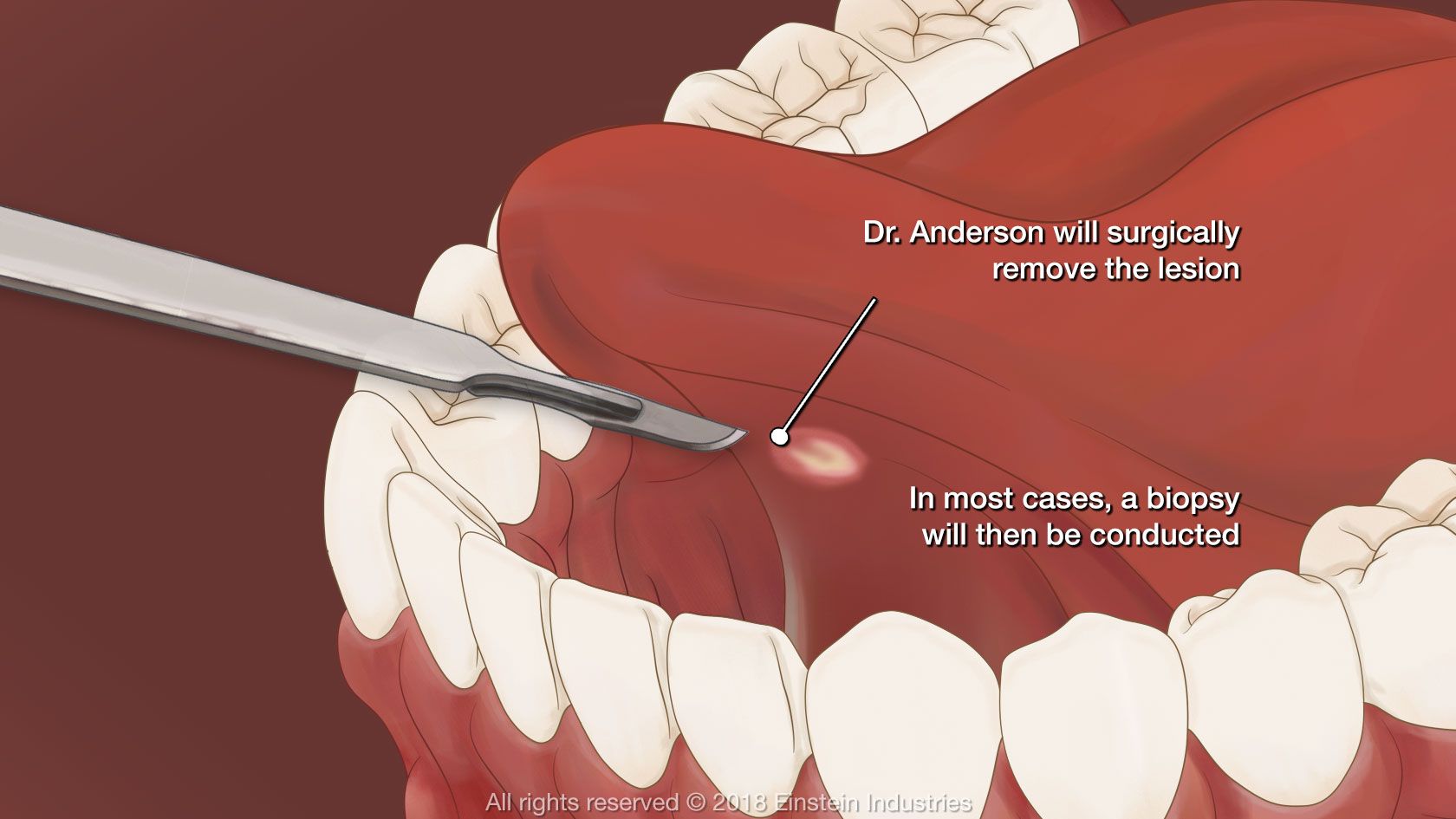 Illustration showing excision of a lesion